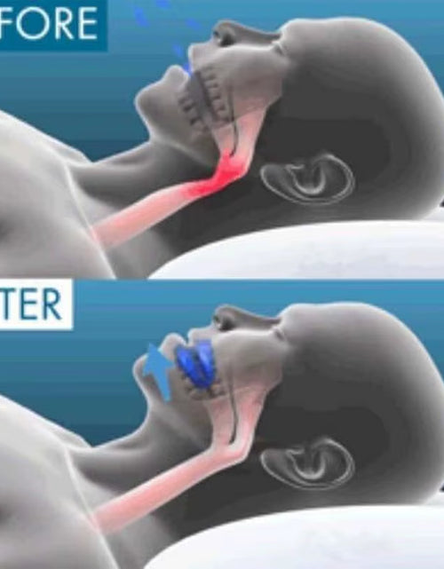 Load image into Gallery viewer, Snore Stopper – Sleep Deeper, Breathe Easier, Wake Refreshed
